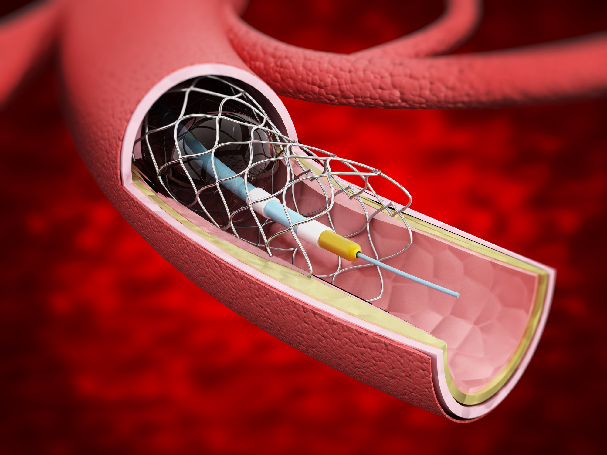 Verification, Validation, and Uncertainty Quantification for Medical Device Simulation